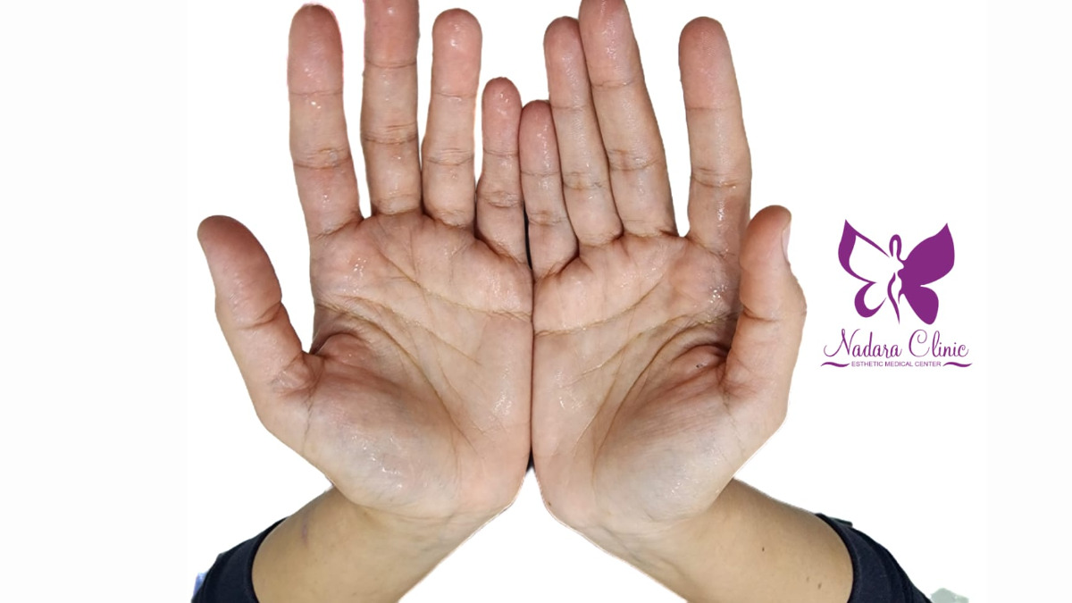 Botox for excessive sweating in Hurghada